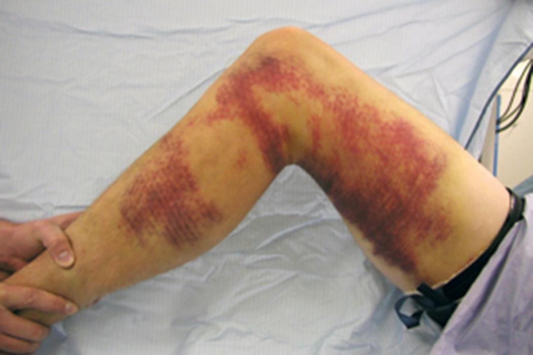 Fig. 1.1, A clinical photograph of an injured left knee demonstrates extensive lateral ecchymosis. Also visible is posterior sag of the tibia consistent with a posterior cruciate ligament injury.