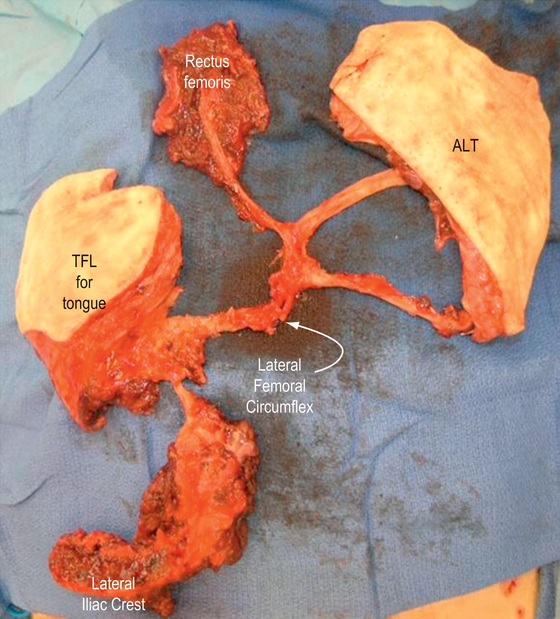 Figure 1.15, Lateral circumflex femoral artery system. ALT, anterolateral thigh; TFL, tensor fasciae latae.