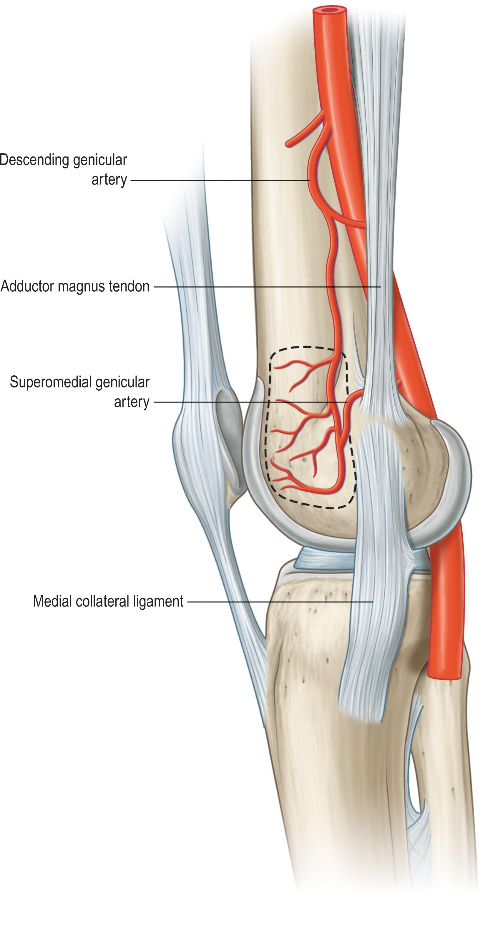 Figure 1.5, The medial femoral periosteal bone flap.