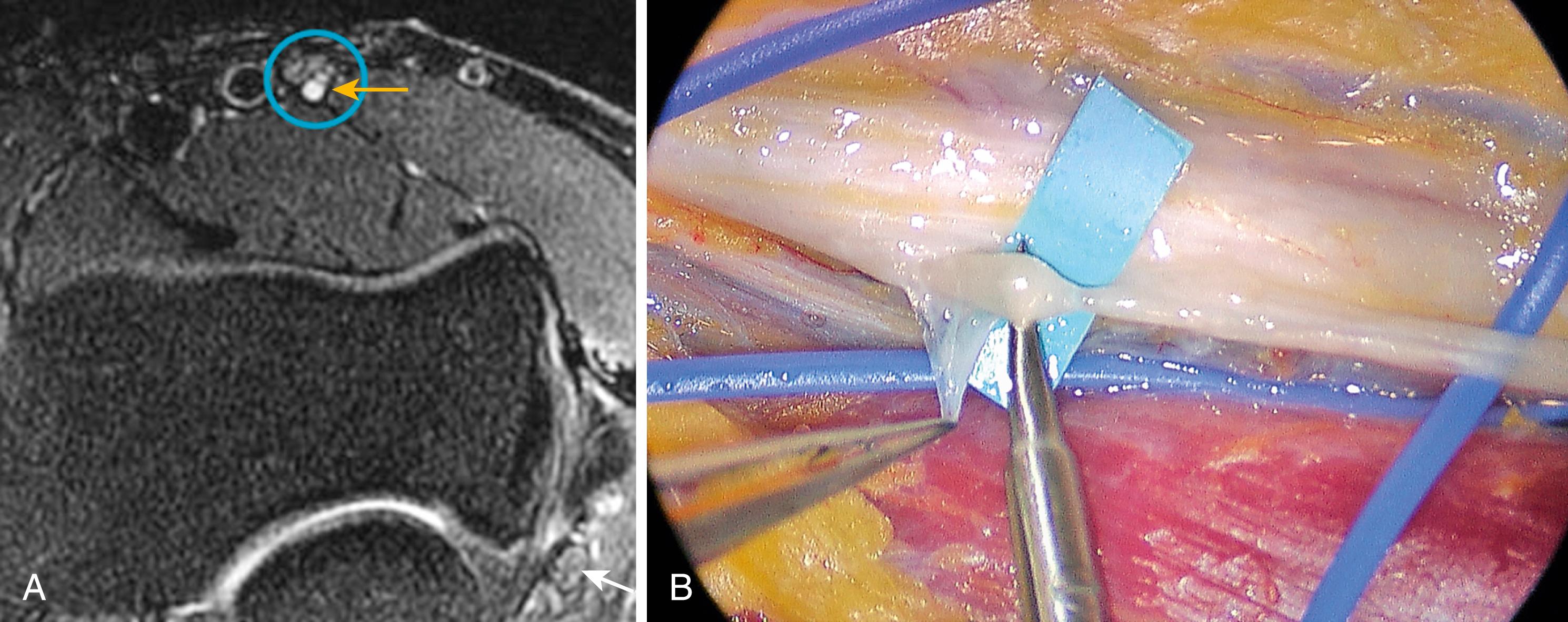 Fig. 28.11, Anterior interosseous nerve syndrome caused by neuralgia amyotrophy (Parsonage-Turner syndrome). A, Magnetic resonance neurography of the supracondylar humeral region, demonstrating increased signal intensity and swelling of the posteromedial fascicle (anterior interosseous fascicle, yellow arrow ) of the median nerve (blue circle) . Note the normal ulnar nerve in comparison (lower right corner, white arrow) . B, The median nerve following epineurolysis above the elbow, and displaying the gross prestenotic swelling and fascicular constriction of the anterior interosseous fascicle (blue background) .