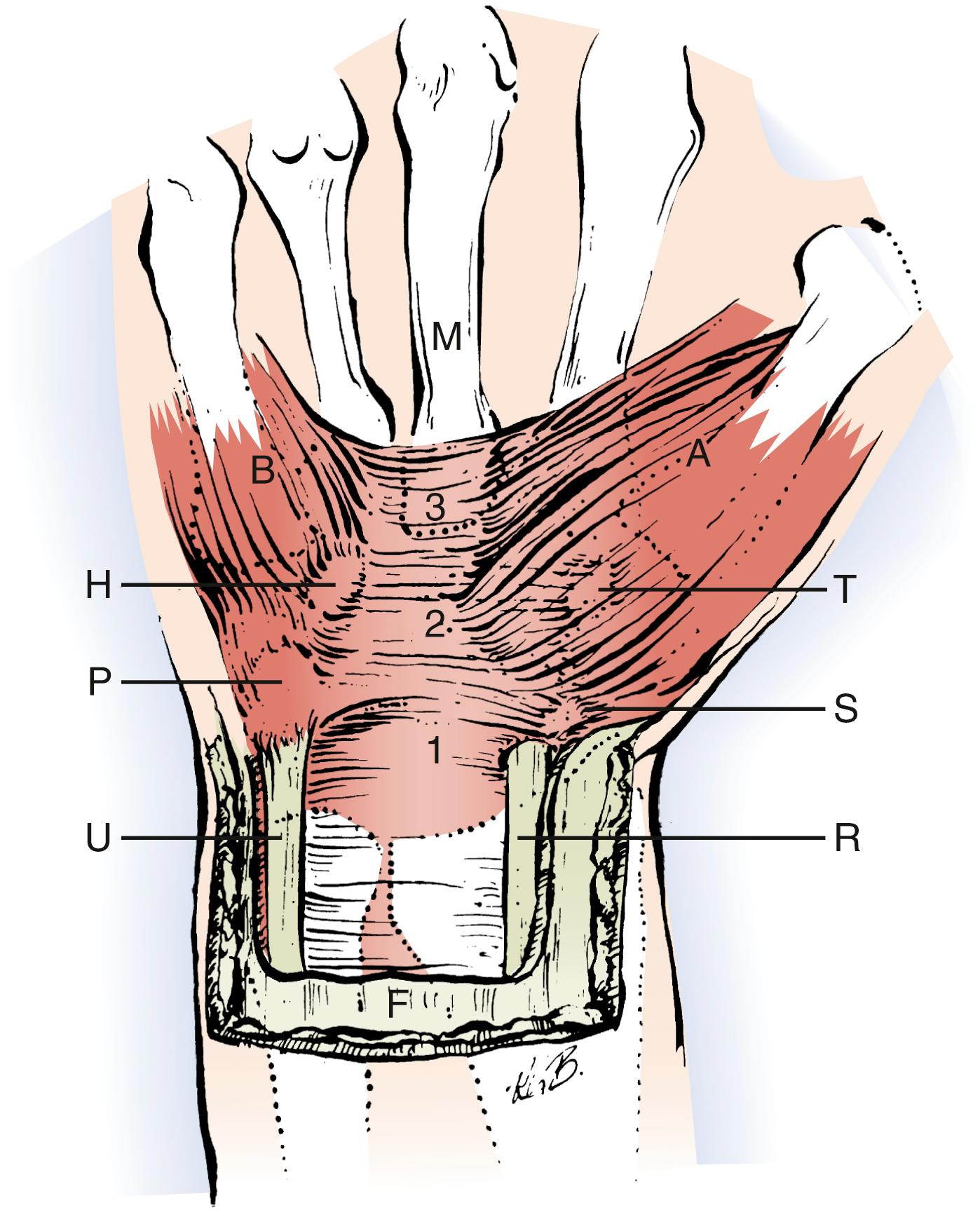 Fig. 28.4, Anatomy of the three portions of the flexor retinaculum. The distal portion of the flexor retinaculum (3) consists of a thick aponeurosis between the thenar (A) and hypothenar (B) muscles. The thenar muscles attach to the radial half of the classic flexor retinaculum, which is composed of the distal portion of the flexor retinaculum (3) and the transverse carpal ligament (2). Bony attachments of the transverse carpal ligament—pisiform (P), hamate (H), tubercle of the trapezium (T), and tubercle of the scaphoid (S)—are also shown. The proximal portion of the flexor retinaculum (1) courses deep to the flexor carpi ulnaris (U) and flexor carpi radialis (R). The flexor carpi radialis tendon is shown as it pierces the flexor retinaculum at the junction of the proximal and middle portions to enter its fibroosseous canal. F, Antebrachial fascia; M, third metacarpal.