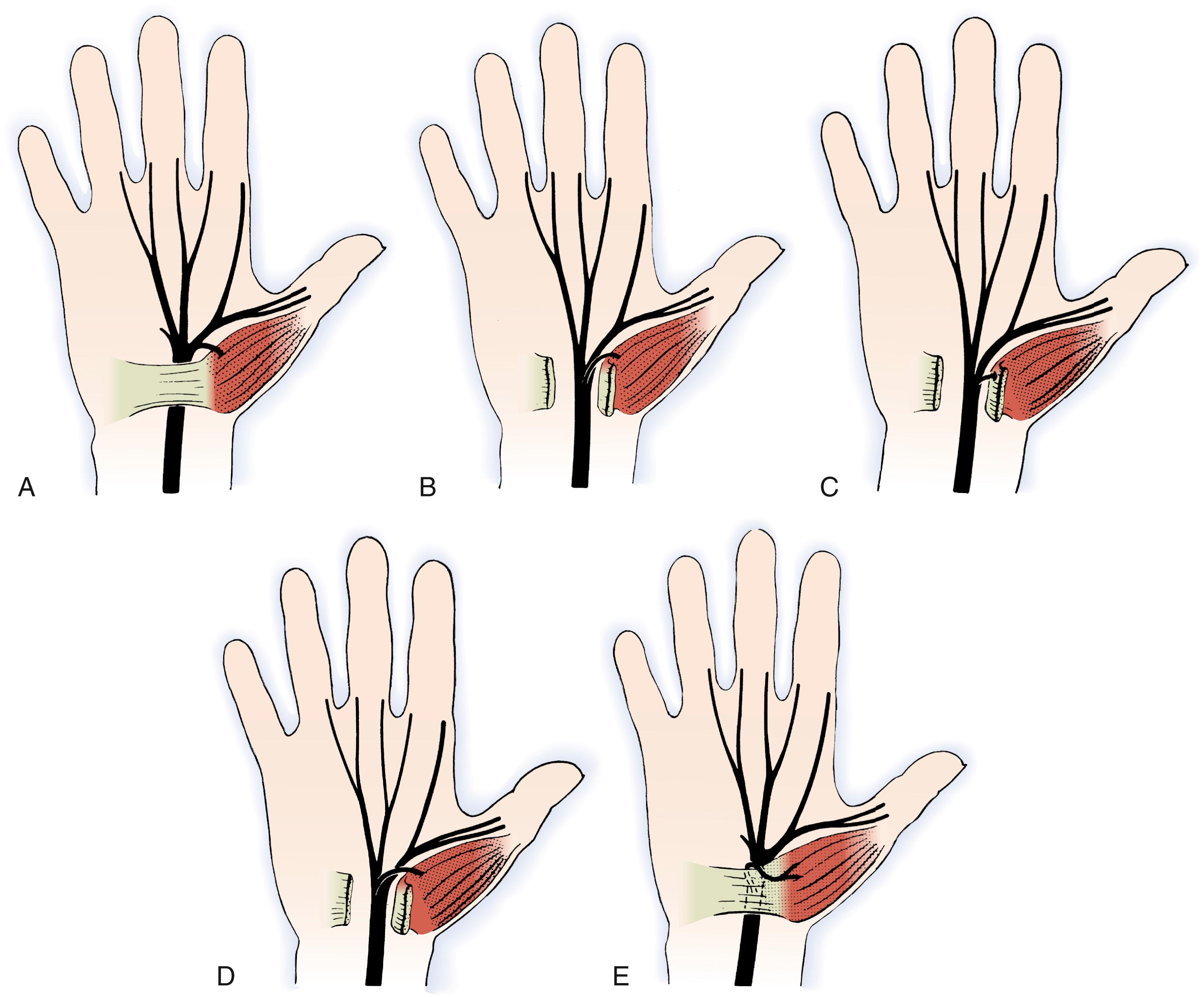 Fig. 28.5, Variations in median nerve anatomy in the carpal tunnel. A, The most common pattern of the motor branch is extraligamentous and recurrent. B, Subligamentous branching of a recurrent median nerve. C, Transligamentous course of the recurrent branch of the median nerve. D, The motor branch can uncommonly originate from the ulnar border of the median nerve. E, The motor branch can lie on top of the transverse carpal ligament.