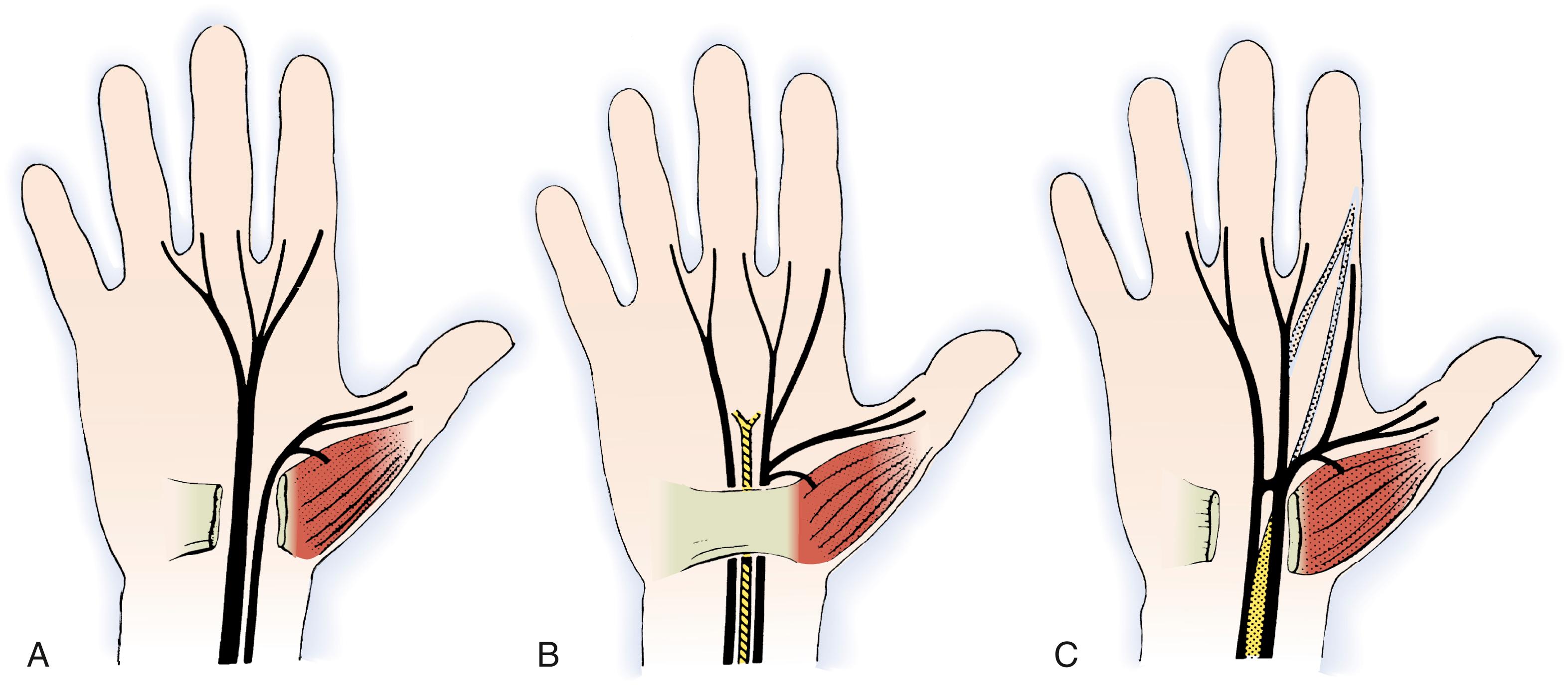 Fig. 28.6, Variations in median nerve anatomy in the carpal tunnel. Group III variations include high divisions of the median nerve (A) that may be separated by a persistent median artery (B) or an aberrant muscle (C) . (From Lanz U. Anatomic variations of the median nerve in the carpal tunnel. J Hand Surg Am. 1977;2[1]:44–53.)