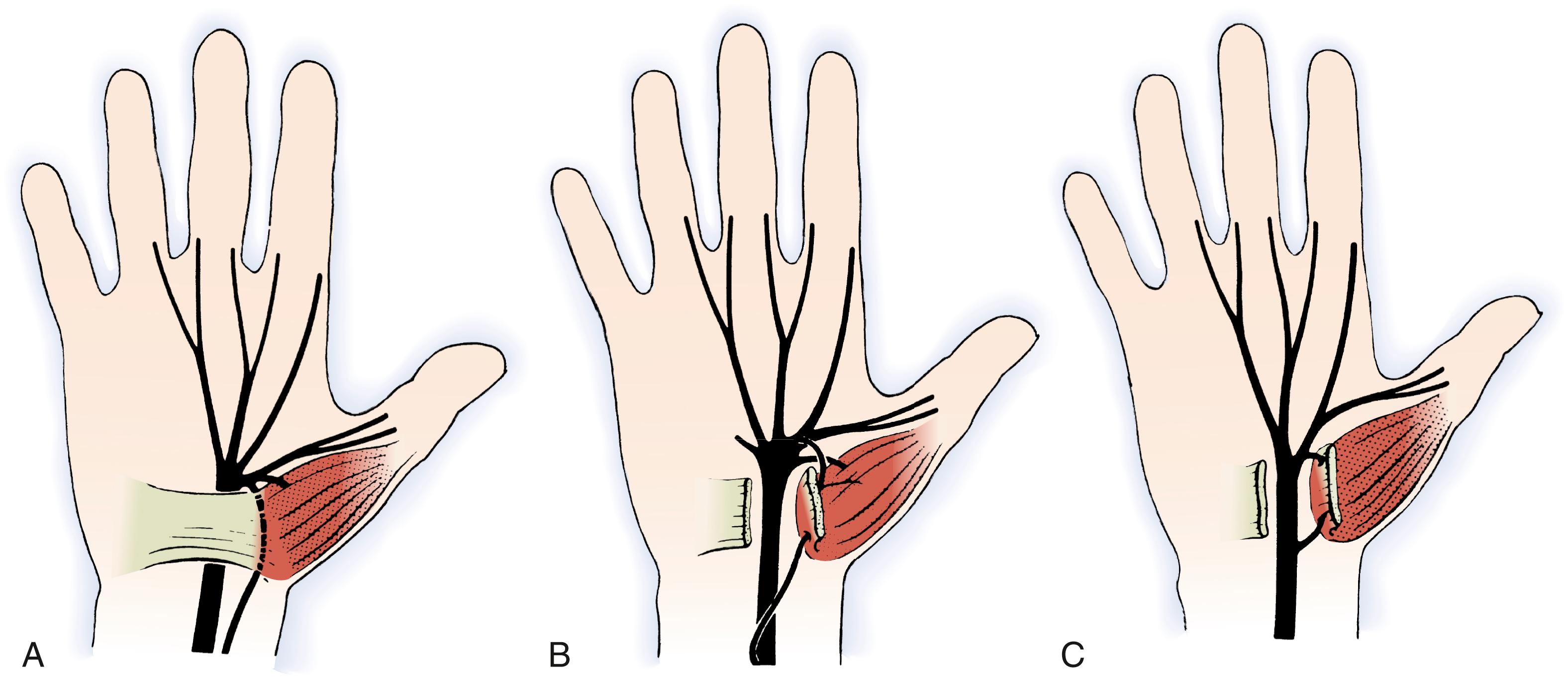 Fig. 28.7, Variations in median nerve anatomy in the carpal tunnel. Group IV variations include rare instances in which the thenar branch leaves the median nerve proximal to the carpal tunnel: A, accessory branch; B, accessory branch from the ulnar aspect of the median nerve; C, accessory branch running directly into the thenar musculature.
