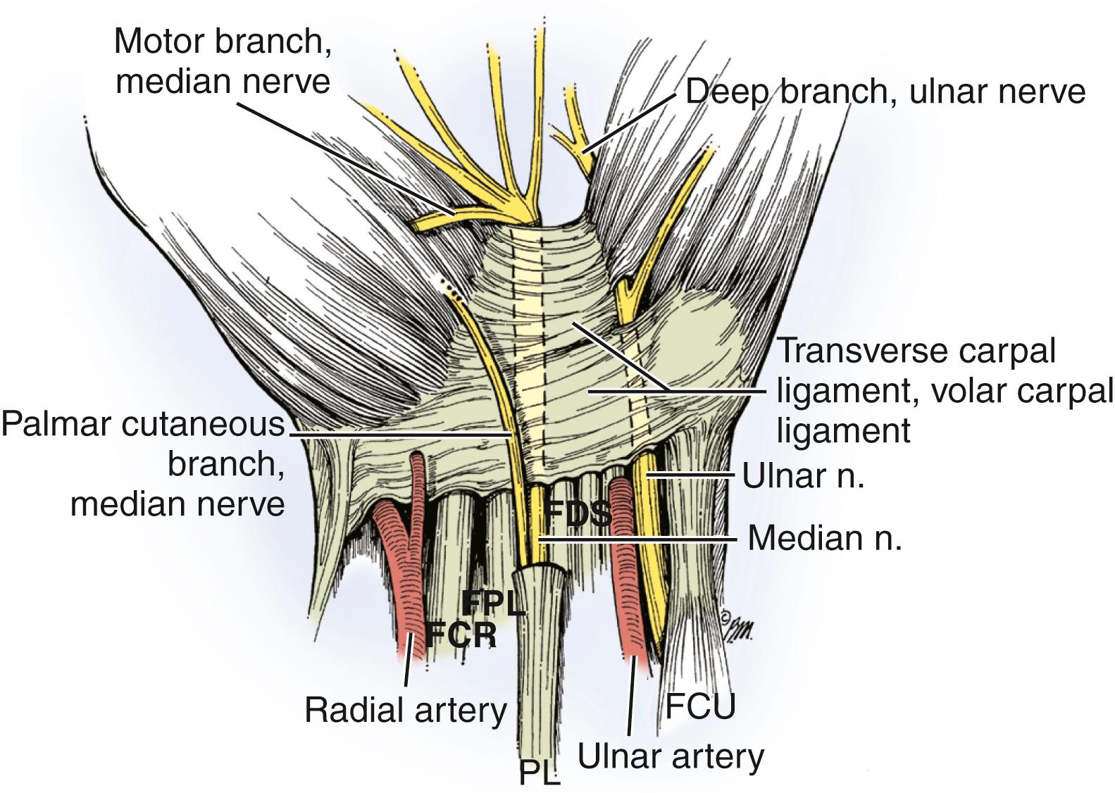 Fig. 28.8, The palmar cutaneous branch of the median nerve lies radial to the median nerve and ulnar to the flexor carpi radialis (FCR) tendon. It may pierce either the volar carpal or transverse carpal ligament or the antebrachial fascia before it becomes subcutaneous. FCU, Flexor carpi ulnaris; FDS, flexor digitorum superficialis; FPL, flexor pollicis longus; PL, palmaris longus. (Copyright © Elizabeth Martin.)