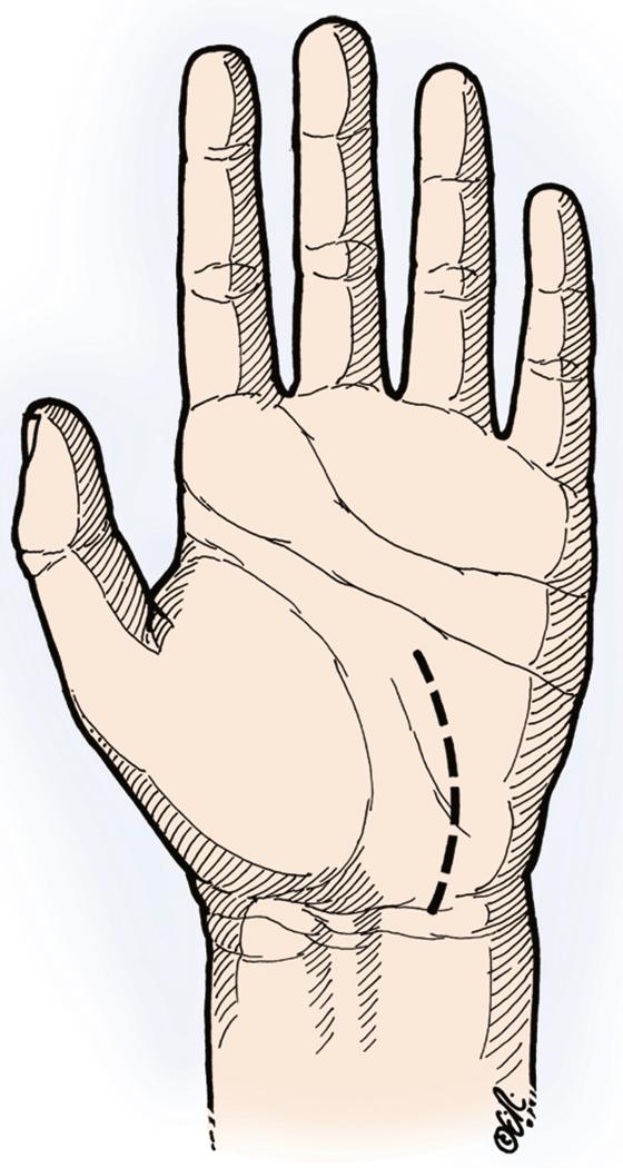 Fig. 28.9, Authors’ preferred carpal tunnel incision. A curved longitudinal incision is made so that it parallels the thenar crease and crosses the wrist crease obliquely in an ulnar direction at a point in line with the long axis of the flexed ring finger or just on the ulnar side of the palmaris longus tendon.