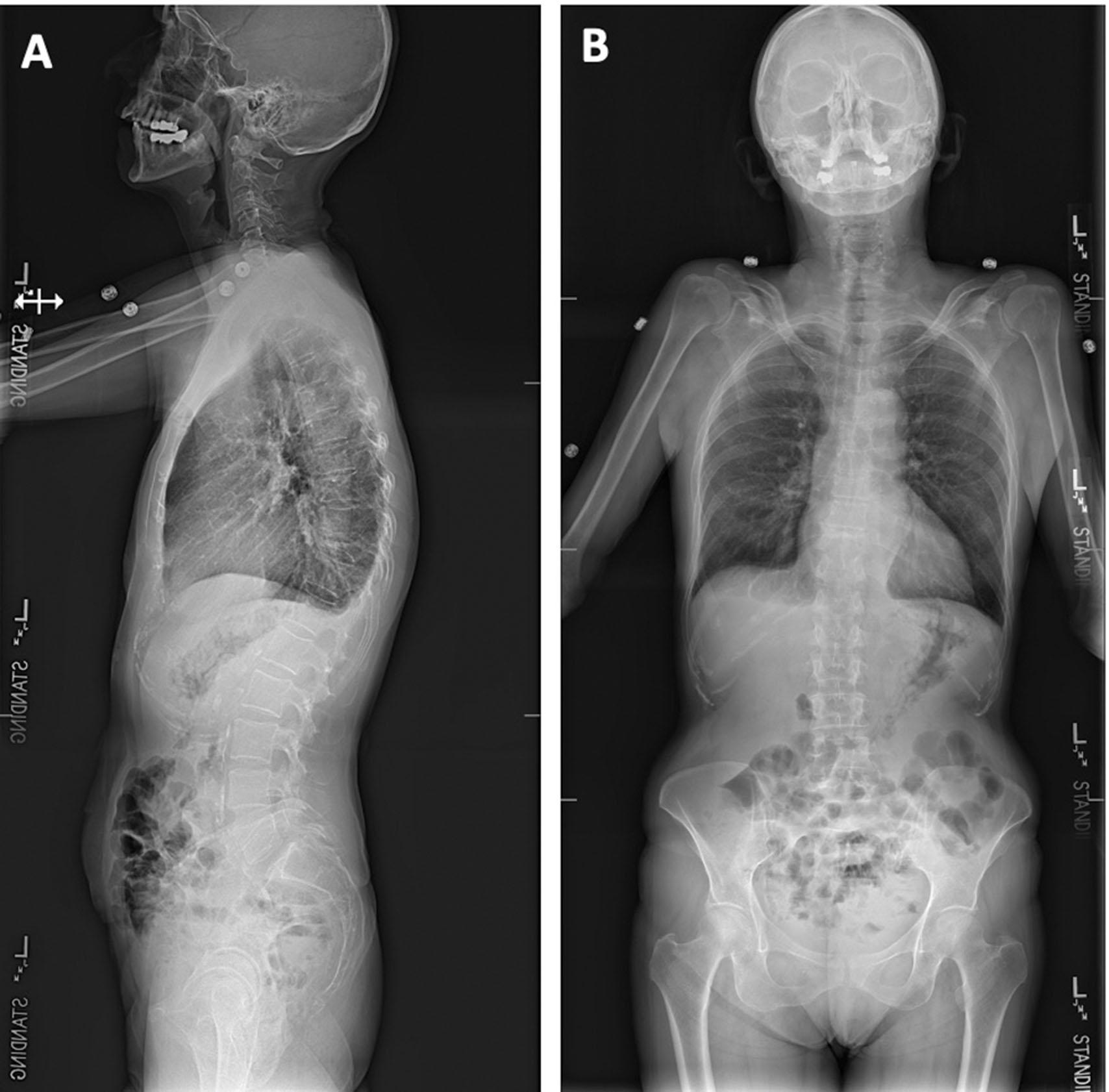 Fig. 24.3, Preoperative x-rays. (A) Anteroposterior (AP) and (B) lateral x-rays demonstrating a T10 compression fracture with focal kyphosis but no global imbalance present.