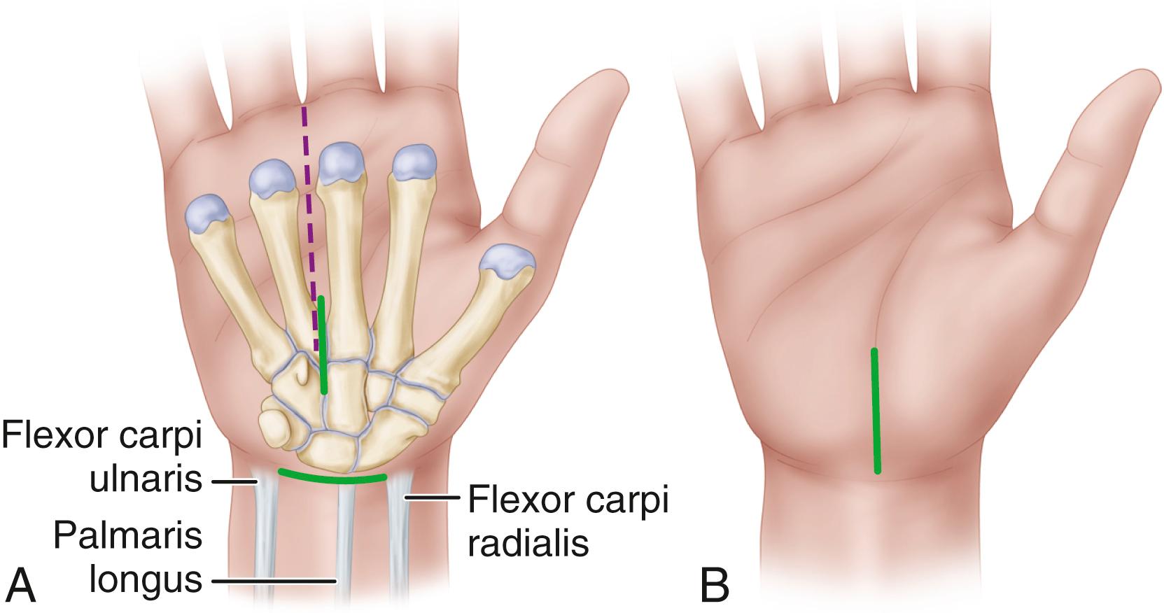 FIGURE 77.1, Two approaches for open carpal tunnel release. A, Transverse incision proximal to anterior wrist crease between flexor carpi ulnaris and flexor carpi radialis tendons. Distal longitudinal incision made between proximal palmar crease and 1 cm distal to hamate hook in line with radial border of ring finger. B, Incision used for minimal-incision approach.