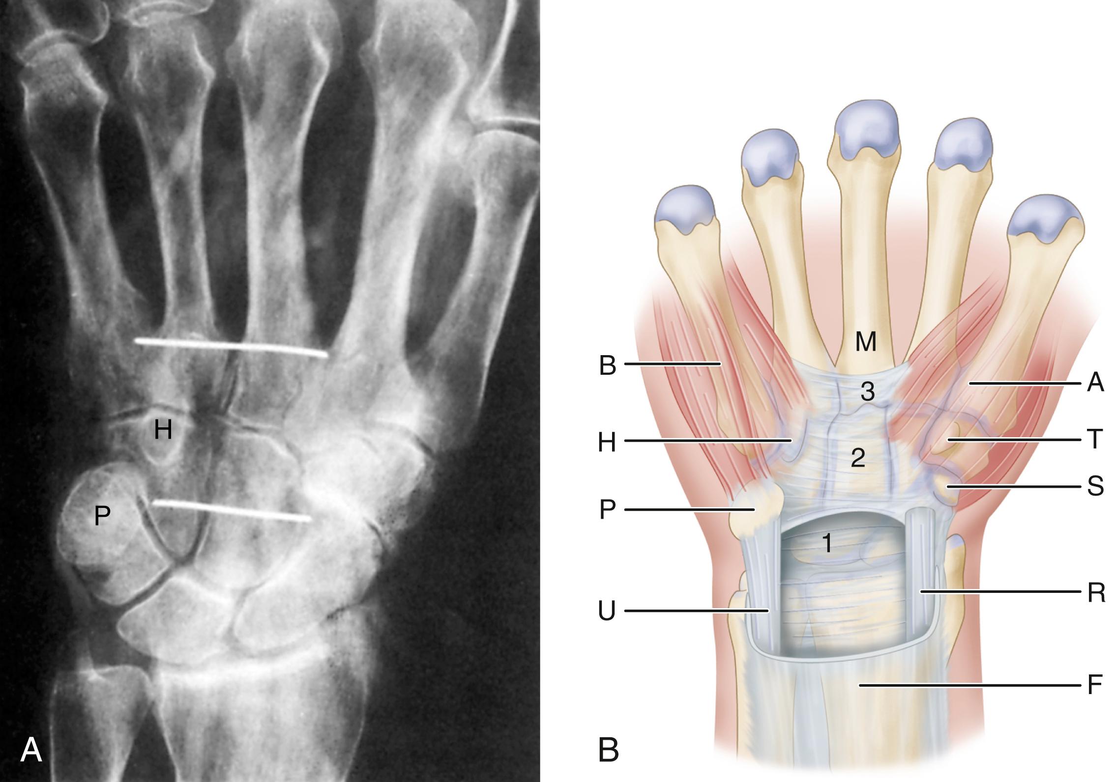 FIGURE 77.2, A, Anteroposterior radiograph of dissected right hand. Wires mark proximal and distal extents of classic flexor retinaculum, which includes middle portion of flexor retinaculum (transverse carpal ligament) and distal portion of flexor retinaculum. Note proximal limit is at distal aspect of pisiform (P) and distal limit is distal to hook of hamate (H) . B, Three portions of flexor retinaculum (1 to 3) consist of thick aponeurosis between thenar (A) and hypothenar (B) muscles. Thenar muscles attach to radial half of classic flexor retinaculum, composed of distal portion of flexor retinaculum (3) ; trapezial ridge (T) and scaphoid tubercle (S) also are shown. Proximal portion of flexor retinaculum (1) courses deep to flexor carpi ulnaris (U) and flexor carpi radialis (R) . Flexor carpi radialis tendon is shown as it pierces flexor retinaculum at junction of proximal and middle portions to enter its fibroosseous canal. F , Antebrachial fascia; M , third metacarpal.