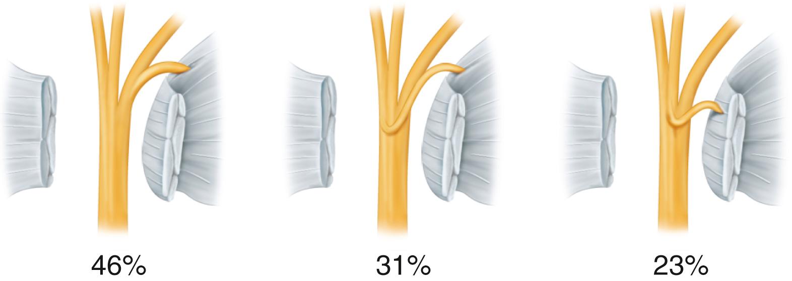 FIGURE 77.5, Incidence of extraligamentous, subligamentous, and transligamentous course of thenar branch. SEE TECHNIQUE 77.2.