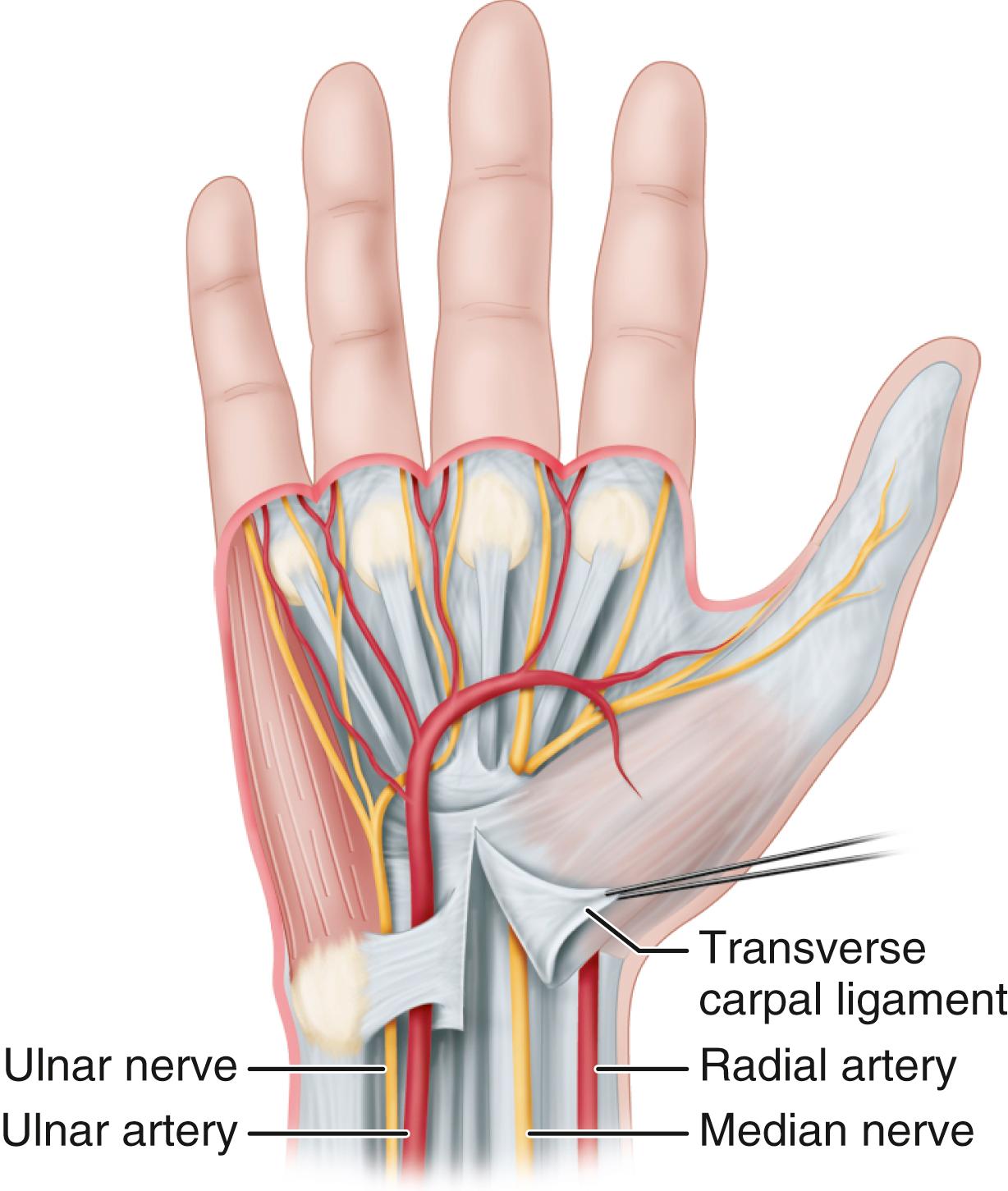 FIGURE 77.6, Anatomic relationships of deep transverse carpal ligament. SEE TECHNIQUE 77.2.