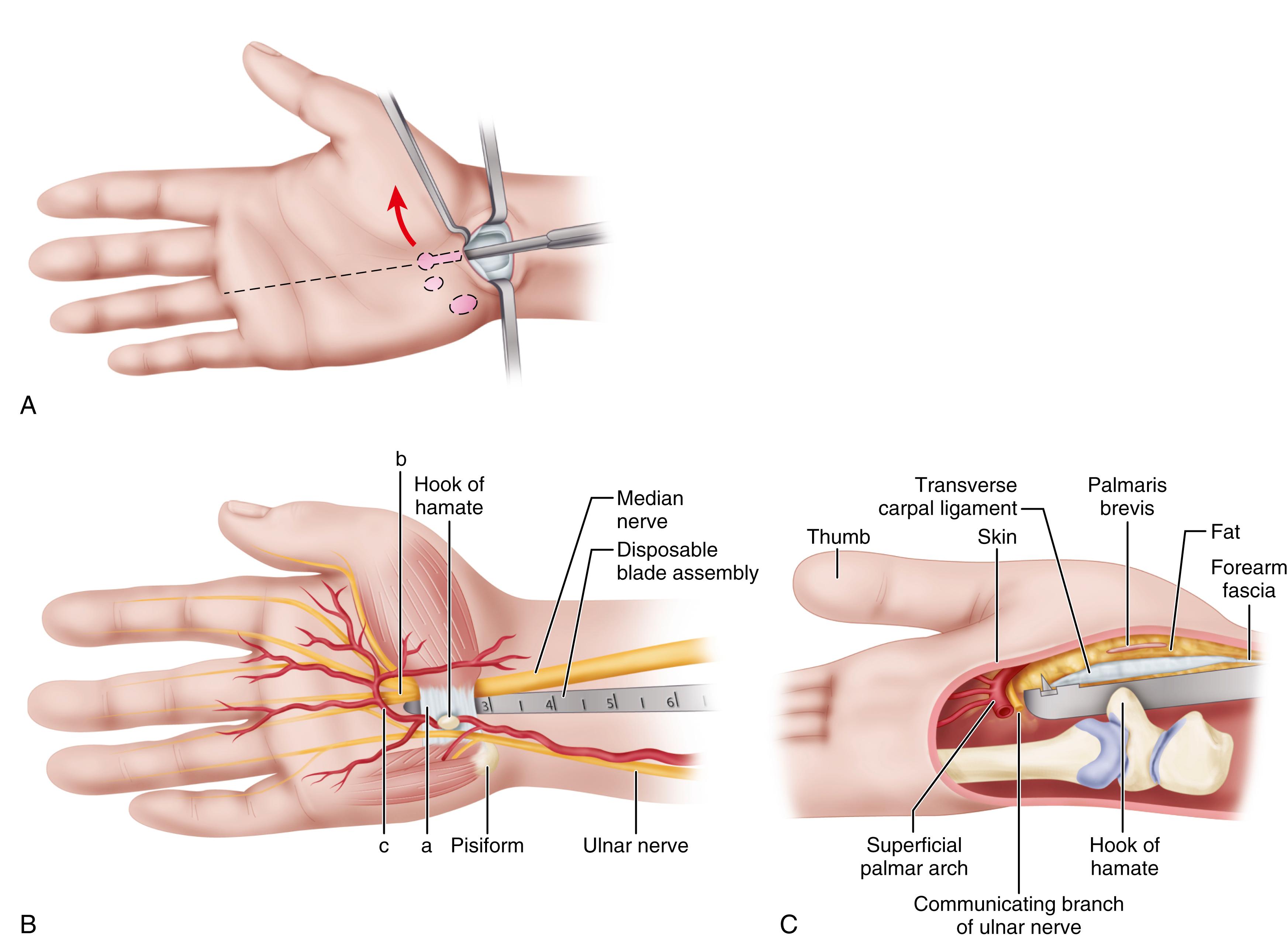 FIGURE 77.7, Agee technique. A , U-shaped flap elevated in palmar direction. Synovium elevator prepares wrist for optimal endoscopic view by separating synovium from deep side of ligament. B , Safe zone of blade elevation is triangle defined by ulnar half of distal edge of transverse carpal ligament (a) ulnar border of median nerve, (b) median nerve common digital branch to long/ring web space, and (c) superficial palmar arch. C , Longitudinal cross section through carpal tunnel depicts blade elevation in triangular safe zone. D , Initial release facilitates accurate viewing and division of ligament. E , Inspection of incised transverse carpal ligament in which left view depicts incomplete release as V-shaped defect, with superficial fibers of transverse carpal ligament remaining intact. Center view depicts complete release of ligament after reinsertion of blade assembly. Fat and transverse fibers of palmar fascia that remain palmar to divided ligament can be noted. View on right shows that rotating blade assembly approximately 20 degrees in either direction causes separated cut edges of ligament to fall into window. F , Tenotomy scissors used to release forearm fascia proximal to skin incision. SEE TECHNIQUE 77.3.