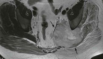 FIGURE 35–1, Compression of the sciatic nerve at the sacrosciatic notch by a soft tissue sarcoma. Axial T1-weighted MR image of the pelvis demonstrates a soft tissue sarcoma (arrows) within the sacrosciatic notch.