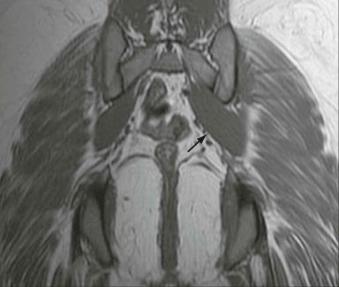 FIGURE 35–2, Piriformis syndrome. Coronal T1-weighted MR image shows hypertrophy of the left piriformis muscle (arrows).