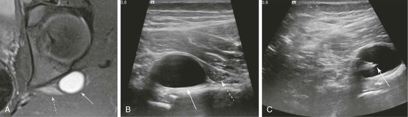 FIGURE 35–3, Compression of the sciatic nerve at the hip by a ganglion cyst. A , Axial fat-saturated T2-weighted image showing a ganglion cyst (solid arrow) as a hyperintense T2 oval structure next to the sciatic nerve (dashed arrow). The sciatic nerve is increased in signal likely secondary to neuritis from compression by the ganglion cyst. B , Ultrasound image showing the ganglion cyst as an anechoic oval structure (solid arrow) next to the sciatic nerve (dashed arrow). C , Ultrasound guided aspiration of the cyst with the needle tip inside of the cyst (solid arrow).