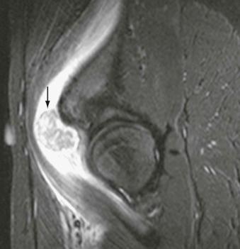 FIGURE 35–4, Iliacus syndrome. Sagittal short tau inversion recovery pulse sequence in a patient with myositis ossificans of the iliopsoas muscle (arrow) producing compression of the femoral nerve in the region of the inguinal ligament.