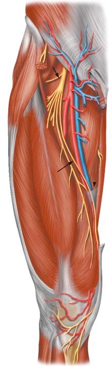 FIGURE 35–5, Normal anatomy of the saphenous nerve. The saphenous nerve (long arrow) originates from the femoral nerve (short arrow) just distal to the inguinal ligament and courses into the adductor canal (arrowhead).