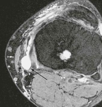 FIGURE 35–6, Saphenous neuropathy. Axial short tau inversion recovery MR image at the level of the knee demonstrating the saphenous nerve (short arrow) compressed between the sartorius muscle (arrowhead) and a fluid-distended semimembranosus bursa (long arrow).