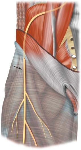 FIGURE 35–8, Normal anatomy of the lateral femoral cutaneous nerve. The nerve (arrow) is located superficially to the crural fascia.