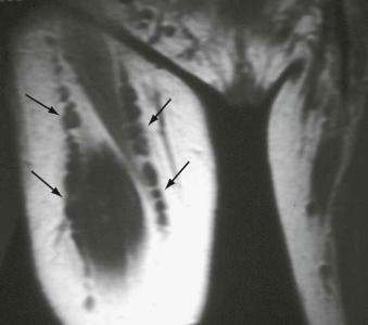 eFIGURE 35–2, Lateral femoral cutaneous neuropathy (meralgia paresthetica). Patient has neurofibromatosis type 1, with multiple neurofibromas (arrows) involving the lateral femoral cutaneous nerve and the anterior femoral cutaneous branches of the femoral nerve.