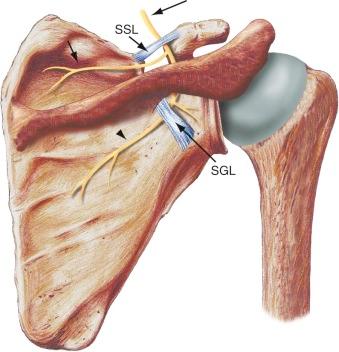 FIGURE 17–1, Normal anatomy of the suprascapular nerve. Drawing of the suprascapular nerve (long arrow) as it courses through the suprascapular notch bounded superiorly by the suprascapular ligament (SSL) . The nerve branches into the supraspinatus nerve (short arrow) and infraspinatus nerve (arrowhead). The infraspinatus nerve has to traverse the spinoglenoid notch, formed between the spinoglenoid ligament (SGL) and the scapula.