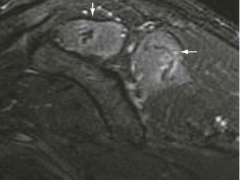 FIGURE 17–2, Early denervation of the supraspinatus and infraspinatus muscles. Sagittal T2-weighted MR image demonstrates edema of the supraspinatus and infraspinatus muscles (arrows) due to early denervation.