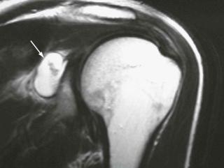 FIGURE 17–3, Ganglion cyst in the suprascapular notch. Coronal T2-weighted MR image demonstrates a fluid collection occupying the suprascapular notch (arrow) compressing the suprascapular nerve.