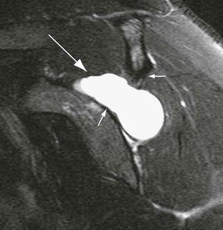 FIGURE 17–4, Ganglion cyst in the spinoglenoid notch. Sagittal T2-weighted image demonstrates a fluid collection (long arrow) in the spinoglenoid notch (short arrows) , compressing the infraspinatus nerve. Note the lack of edema or atrophy of the muscle.