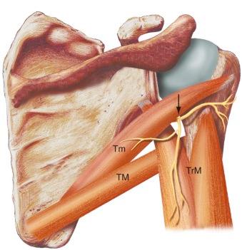 FIGURE 17–5, Drawing of the quadrilateral space. View from the posterior aspect of the scapula demonstrating the four margins of the space: the teres minor muscle superiorly (Tm) , the teres major muscle inferiorly (TM) , the medial aspect of the humerus laterally, and the triceps muscle medially (TrM) . Note the axillary nerve passing though the quadrilateral space (arrow) and providing branches to the teres minor, triceps, and deltoid muscles.