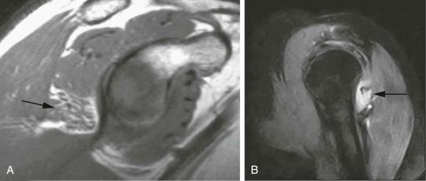 FIGURE 17–6, Teres minor denervation. A, T1-weighted sagittal MR image demonstrates atrophy of the teres minor muscle (arrow) , indicating late stage. B, Sagittal short tau inversion recovery MR image demonstrates early denervation with edema of the teres minor muscle (arrows) .