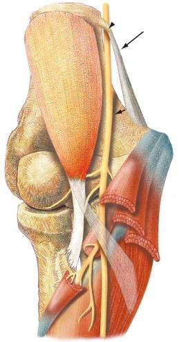 FIGURE 17–7, Normal anatomy of the median nerve at the level of the elbow. The median nerve (short arrow) courses distally from the posterior medial aspect of the arm into the region of the elbow and forearm, where it is located anteromedially. If a supracondylar process is present (arrowhead) , the median nerve is located posterior to the process and the adjacent ligament of Struther (long arrow) . More distally, the median nerve courses under the lacertus fibrosus and the pronator teres and flexor muscles.