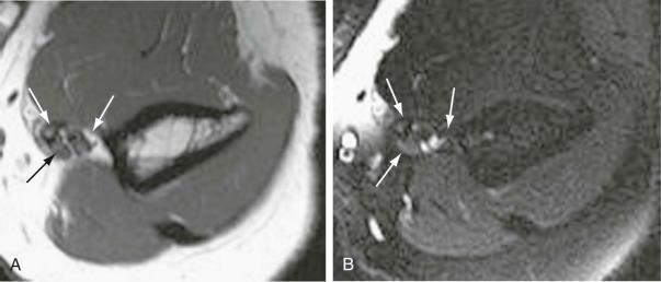 FIGURE 17–8, Entrapment of the median nerve at the level of the supracondylar process. Axial T1-weighted ( A ) and axial short tau inversion recovery (STIR) ( B ) MR images demonstrate a supracondylar process (arrows) with the median nerve located dorsal to the process. Note the increased signal intensity of the median nerve on the STIR image.