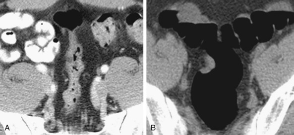 Figure 30-1, A, The collapsed segment of the rectum does not reveal any pathologic process even on careful inspection. B, Well-distended segment in the supine image revealed a 2-cm polyp within the rectum.