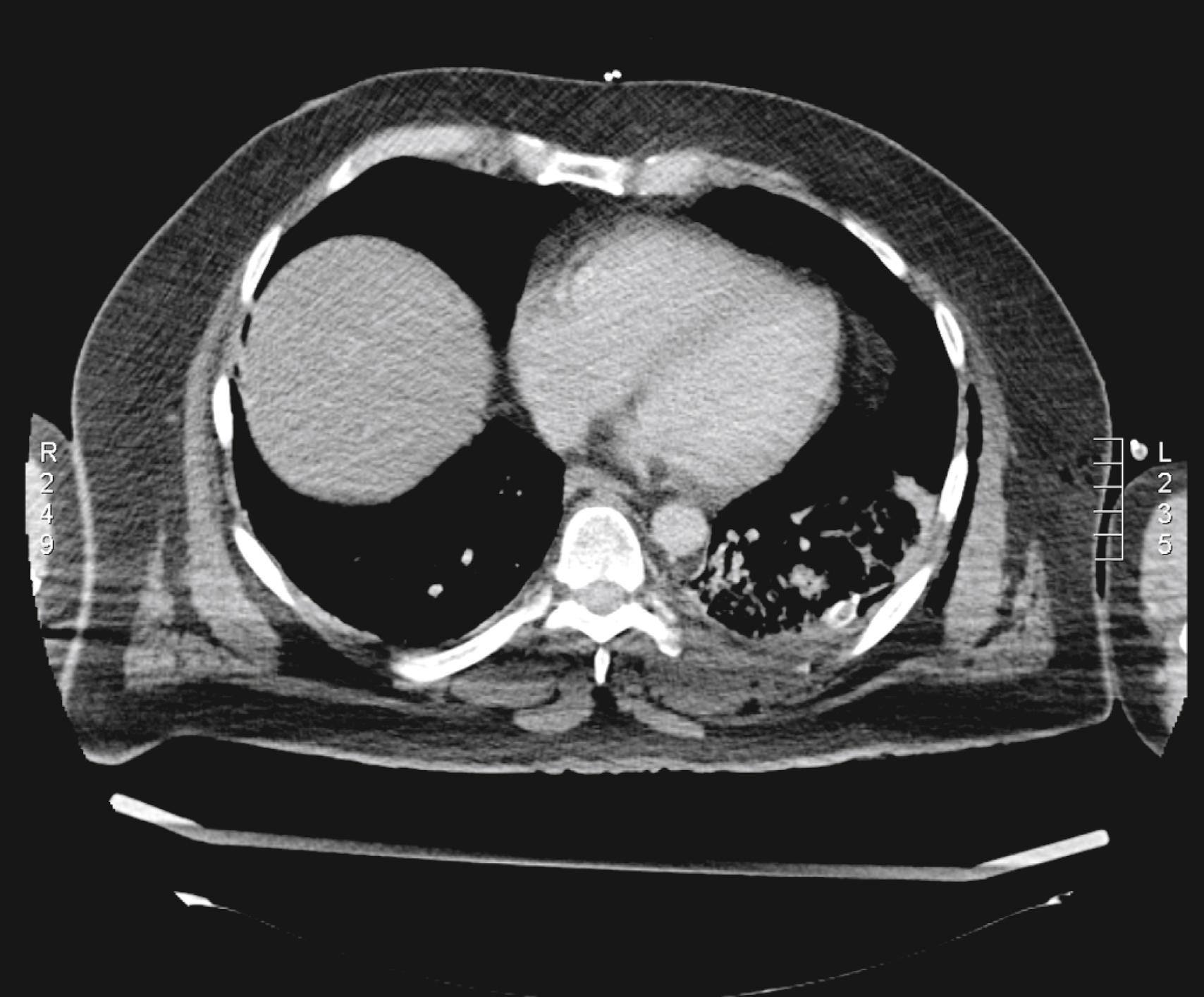 Figure 29.2, Beam-hardening artifacts caused by the humerus as a consequence of scanning with the patient’s arms alongside the upper part of the chest.