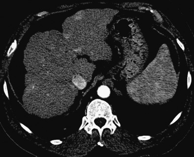 Figure 8-2, Axial image arterial-phase computed tomography scan showing hyperenhancing hepatocellular carcinoma.