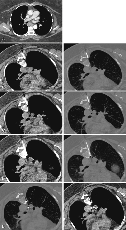 FIG 68-1, Technique to increase pleural space for safe access to middle mediastinum using saline injection. A, This 68-year-old with a history of cervical carcinoma and enlarging subcarinal lymph node presented for CT-guided fiducial placement. B, Soft tissue and bone window images demonstrate narrow window of pleural space, with a 15-gauge coaxial needle being advanced via transcostal approach. C, Saline (5 mL) was instilled to increase pleural space. D, This technique created a safe window for further advancement of the needle to the middle mediastinum through the pleural space without traversing lung parenchyma. E, Final CT images following fiducial placement. No evidence of hematoma or pneumothorax is identified.