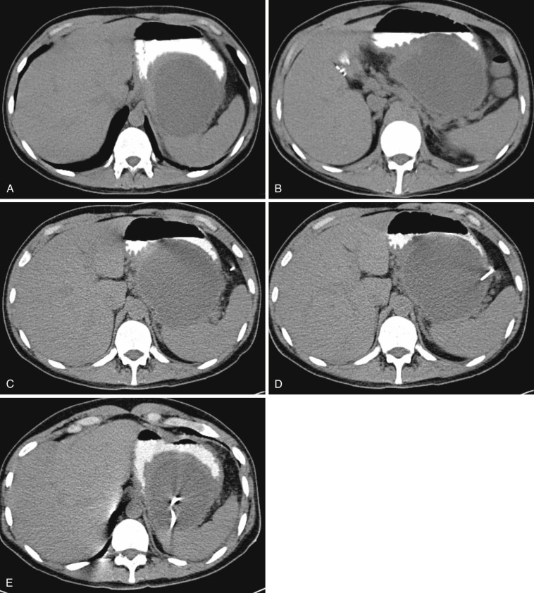 FIG 68-2, This 37-year-old patient presented with worsening leukocytosis and epigastric pain status post pancreatitis. A, CT through the upper abdomen demonstrates a peripancreatic abscess within the left subphrenic region. Abscess is centered at the level of the diaphragm. B, Axial CT image obtained at a level 1 cm caudal to the first image demonstrates adjacent loops of colon in the region of the potential percutaneous access route. A decision was made to target the level between these two images to avoid diaphragm/pleura and adjacent bowel loops. C, A 5F Yueh needle was placed under CT guidance. D, Axial CT image demonstrating Yueh needle within the abscess. E, Final CT image demonstrating satisfactory position of the catheter.