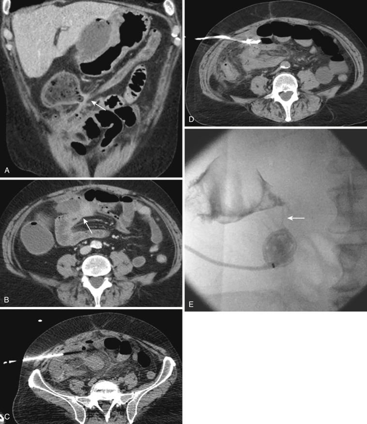 FIG 68-3, This 57-year-old man with a history of chronic pancreatitis and pseudocysts presented with recurrent leukocytosis. A, Coronal CT image through the abdomen demonstrates a loculated peritoneal fluid collection containing gas, with fistulous communication to the adjacent transverse colon (arrow). B, Axial CT image confirms the fistulous communication between this fluid collection and adjacent colon (arrow). C, A 5F Yueh needle was advanced into the fluid collection. D, Postprocedure CT image demonstrates satisfactory position of a 10F catheter. E, Follow-up fluoroscopy-guided sonogram 5 days later. Following contrast injection through the drainage catheter, there is redemonstration of a fistulous communication (arrow) to the adjacent colon with contrast opacification.