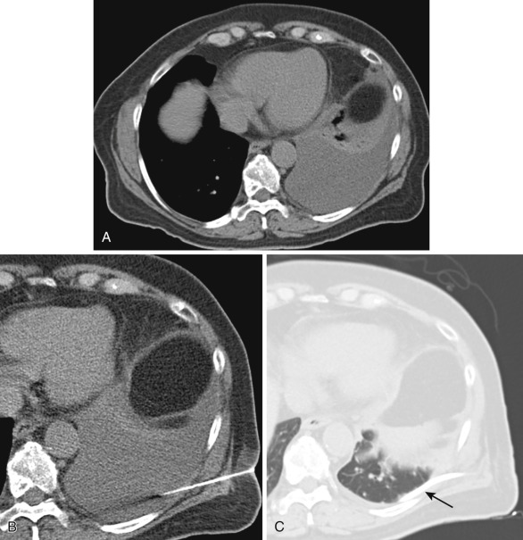 FIG 68-4, This 67-year-old woman with lung cancer presented with worsening shortness of breath and left-sided pleuritic chest pain. A, Axial CT image demonstrates a large amount of left-sided pleural effusion. Diagnostic thoracentesis prior to this procedure resulted in findings consistent with malignant pleural effusion. B, Axial CT image demonstrating 5F Yueh needle advanced through the lateral chest wall toward the dependent aspect of the pleural fluid. C, A 10F catheter (arrow) was placed and resulted in complete drainage of the left-sided pleural effusion.