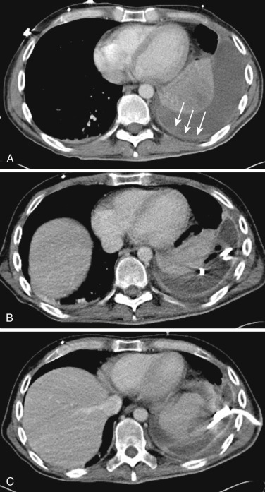 FIG 68-5, This 38-year-old man with a recent history of pneumonia presented with worsening leukocytosis and pleuritic chest pain. A, Preprocedure CT reveals a loculated fluid collection with thick wall, concerning for an empyema. Note enhancing areas of irregularly thickening pleura suggestive of pleural peel (arrows). B, A 10F pigtail drainage catheter was placed. C, Follow-up CT in 16 days for decreased catheter output demonstrates satisfactory position of the catheter and residual empyema, consistent with failed percutaneous drainage. Patient underwent video-assisted thoracoscopic (VATS) drainage of empyema with decortication and pleurectomy.