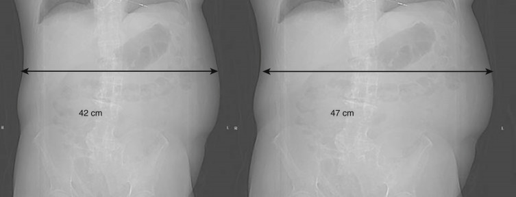 FIG 2-3, Correct (left) and incorrect (right) vertical positioning of the patient and the impact on the localizer radiograph. Correct positioning of the patient in the scanner results in an apparent lateral dimension of 42 cm as measured on the radiography. The patient diameter is measured to be 47 cm in the right image because the patient was positioned above the isocenter for an AP localizer radiograph exposure. The geometric magnification resulting from this miscentering results in a larger apparent patient size that may affect performance of the scanner AEC and result in a higher-than-required radiation dose.