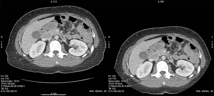 FIG 2-4, Two reconstructions of the same image acquisition. The image on the left shows the patient centered in the reconstructed FOV but demonstrates higher-than-acceptable image noise. The image on the right shows a reconstructed FOV centered at the scanner isocenter instead of on the patient and demonstrates that the patient was positioned too low in the gantry. The mispositioning of the patient resulted in a smaller apparent patient size on the localizer radiograph, which may affect the AEC operation and result in lower-than-required radiation dose for the desired image quality.