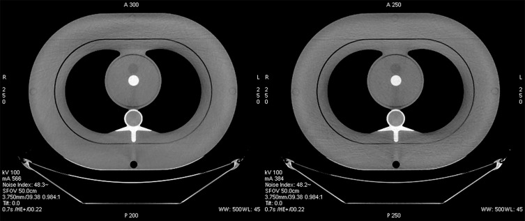 FIG 2-5, The impact on the radiation dose for scans using AEC of improper patient positioning. The image on the left is from a patient positioned too high in the gantry, with a localizer radiography acquired in the AP direction. The CTDI vol required for this examination was 18 mGy. The image on the right is the phantom correctly positioned vertically in the gantry, with a CTDI vol of 12 mGy required.