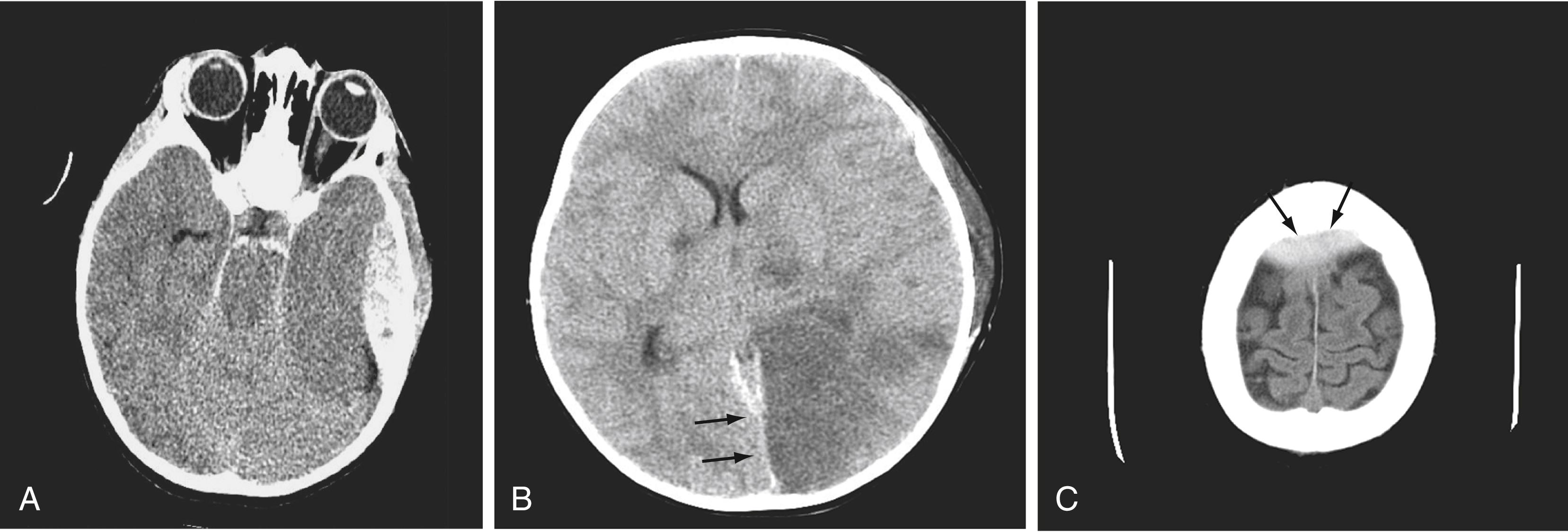 Figure 10.1, (A) Non–contrast-enhanced computed tomographic (CT) image of the head, demonstrating an acute epidural hematoma over the left cerebral hemisphere. Note the biconvex contours of the hematoma. (B) Postoperative CT shows multiple infarctions, including a large left posterior distribution infarction (arrows) of the cerebral artery from compression of this vessel by the epidural hematoma. (C) In a different patient, epidural hematoma at the vertex (arrows), extending across the interhemispheric fissure.