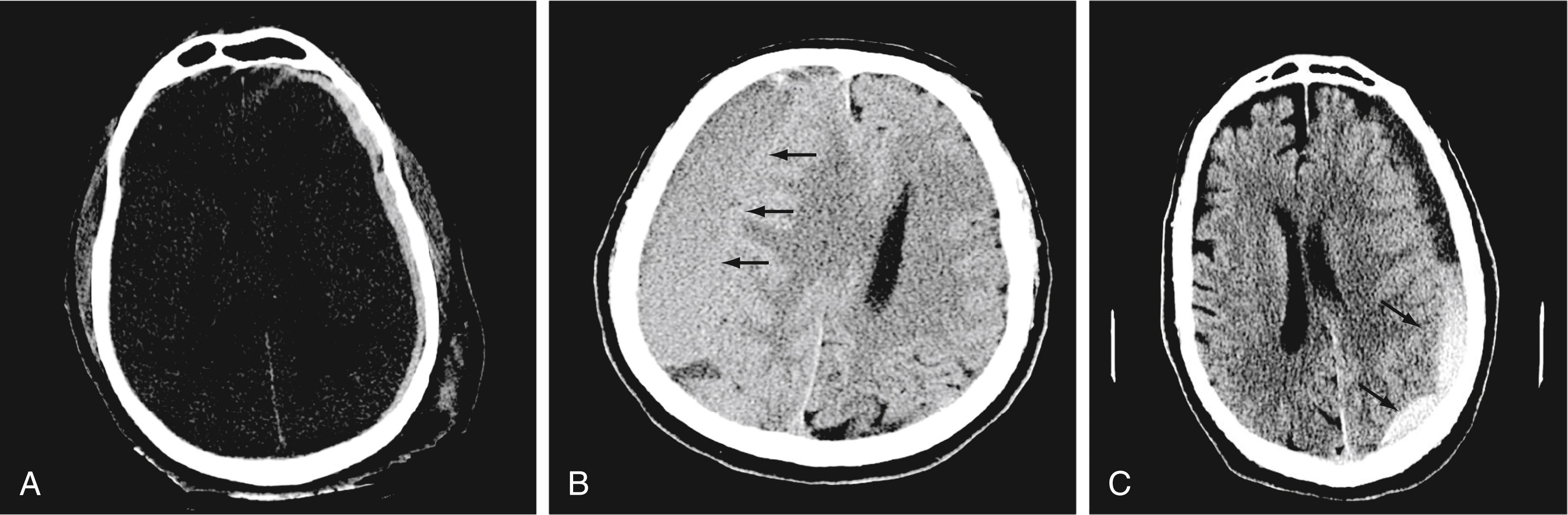 Figure 10.2, (A) Non–contrast-enhanced computed tomographic image of the head, showing a thin left acute subdural hematoma (SDH). (B) Right subacute, nearly isodense SDH (arrows). (C) Acute-on-chronic SDH over the left frontal and parietal lobes (arrows).