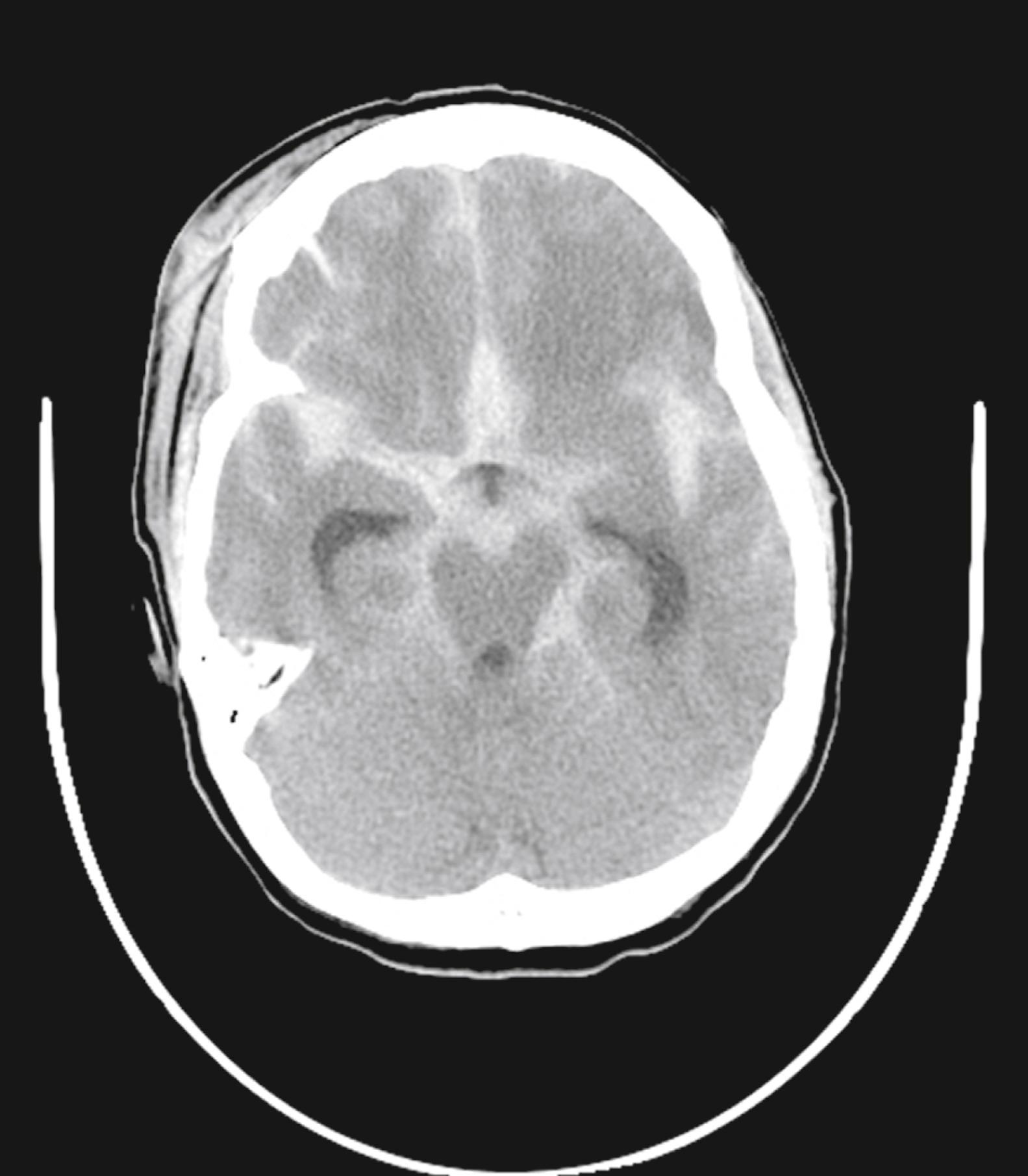 Figure 10.3, Acute diffuse subarachnoid hemorrhages within the suprasellar cistern, ambient cistern, and frontal and temporal sulci.