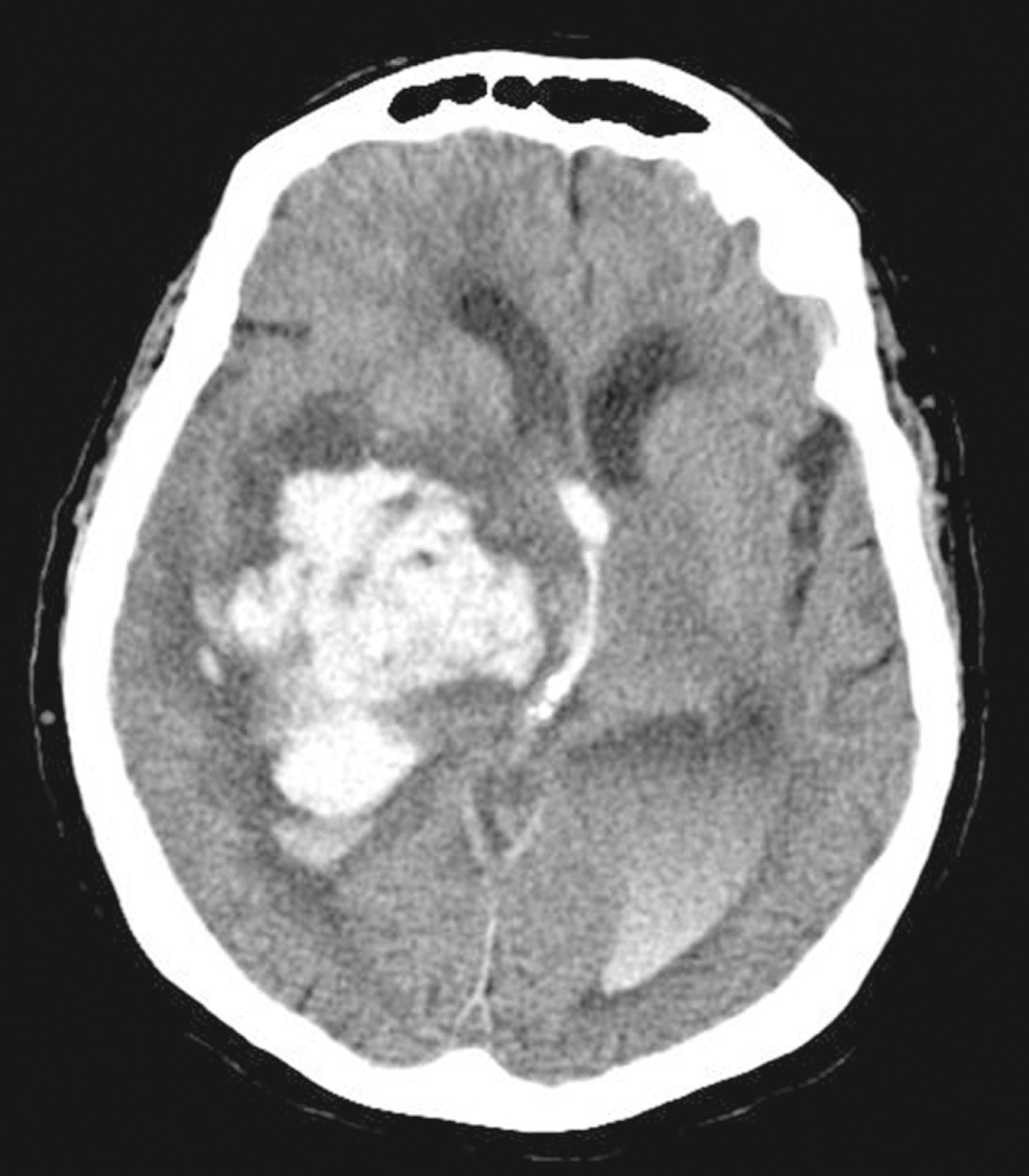 Figure 10.4, Non–contrast-enhanced computed tomographic image of the head, demonstrating an acute right thalamic hypertensive hemorrhage, midline shift to the left, intraventricular hemorrhage, and hydrocephalus.