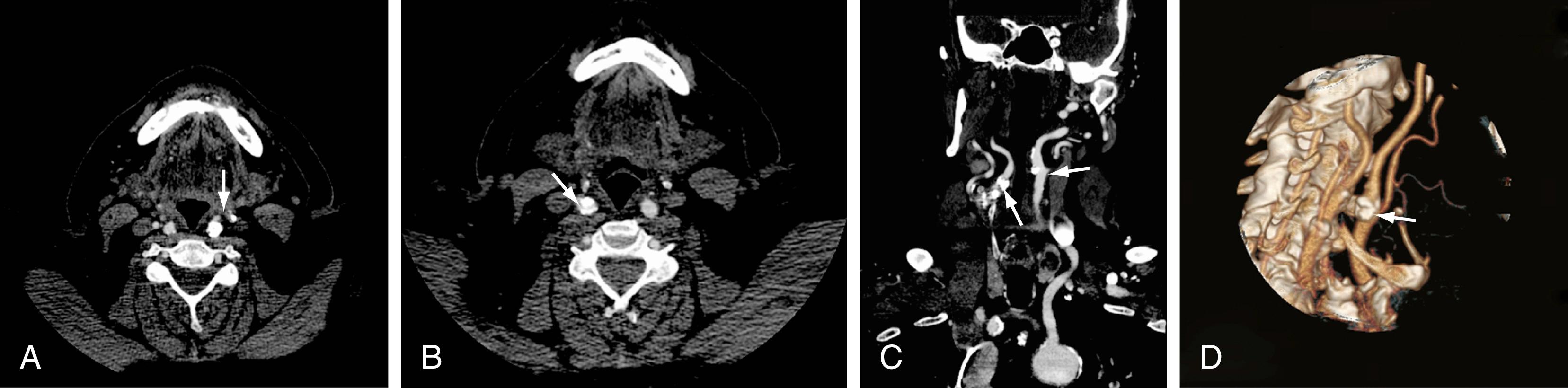 Figure 10.6, Computed tomographic angiograms of the neck.