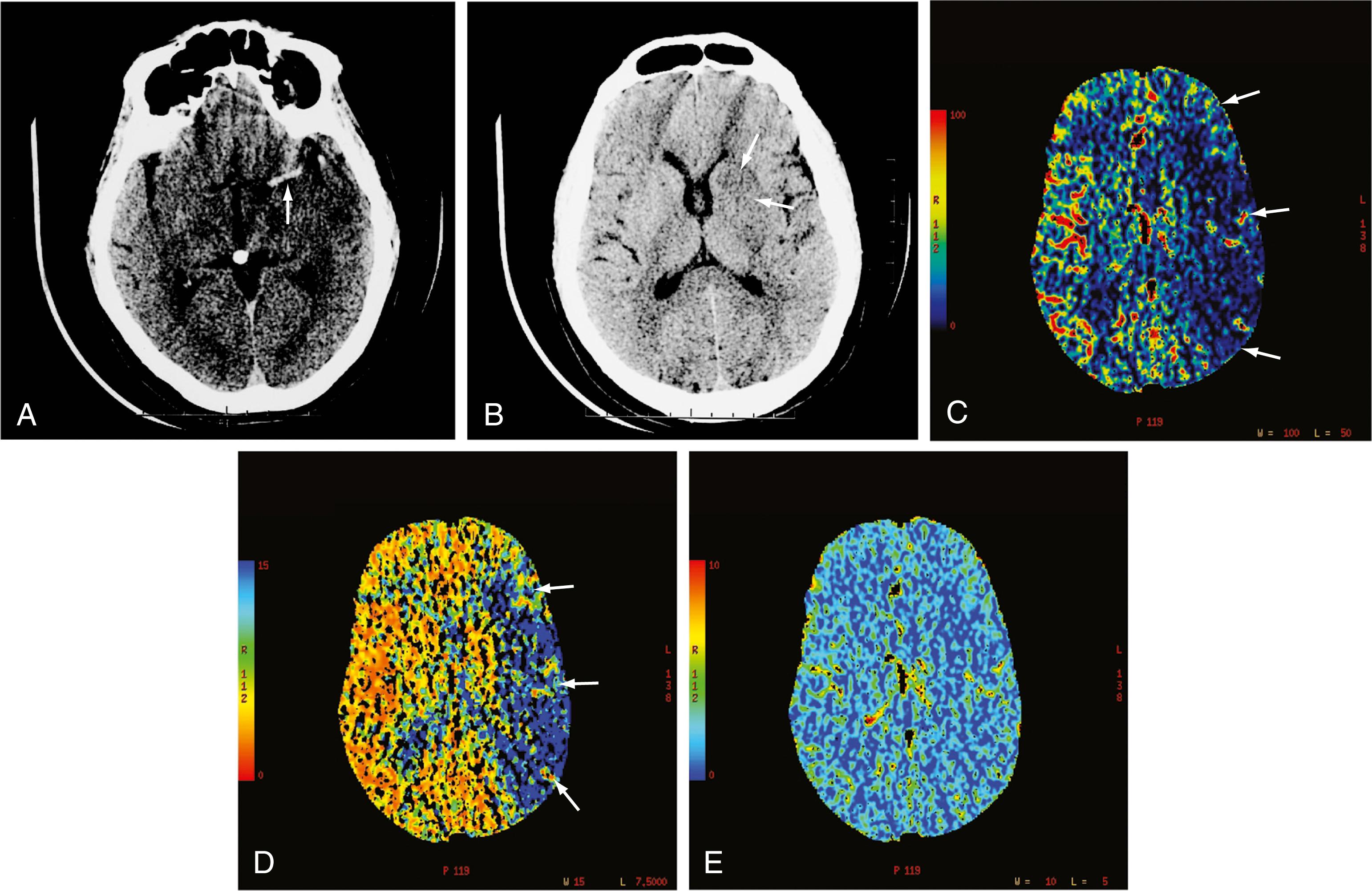 Figure 10.7, Computed tomographic (CT) images of the left middle cerebral artery (MCA).