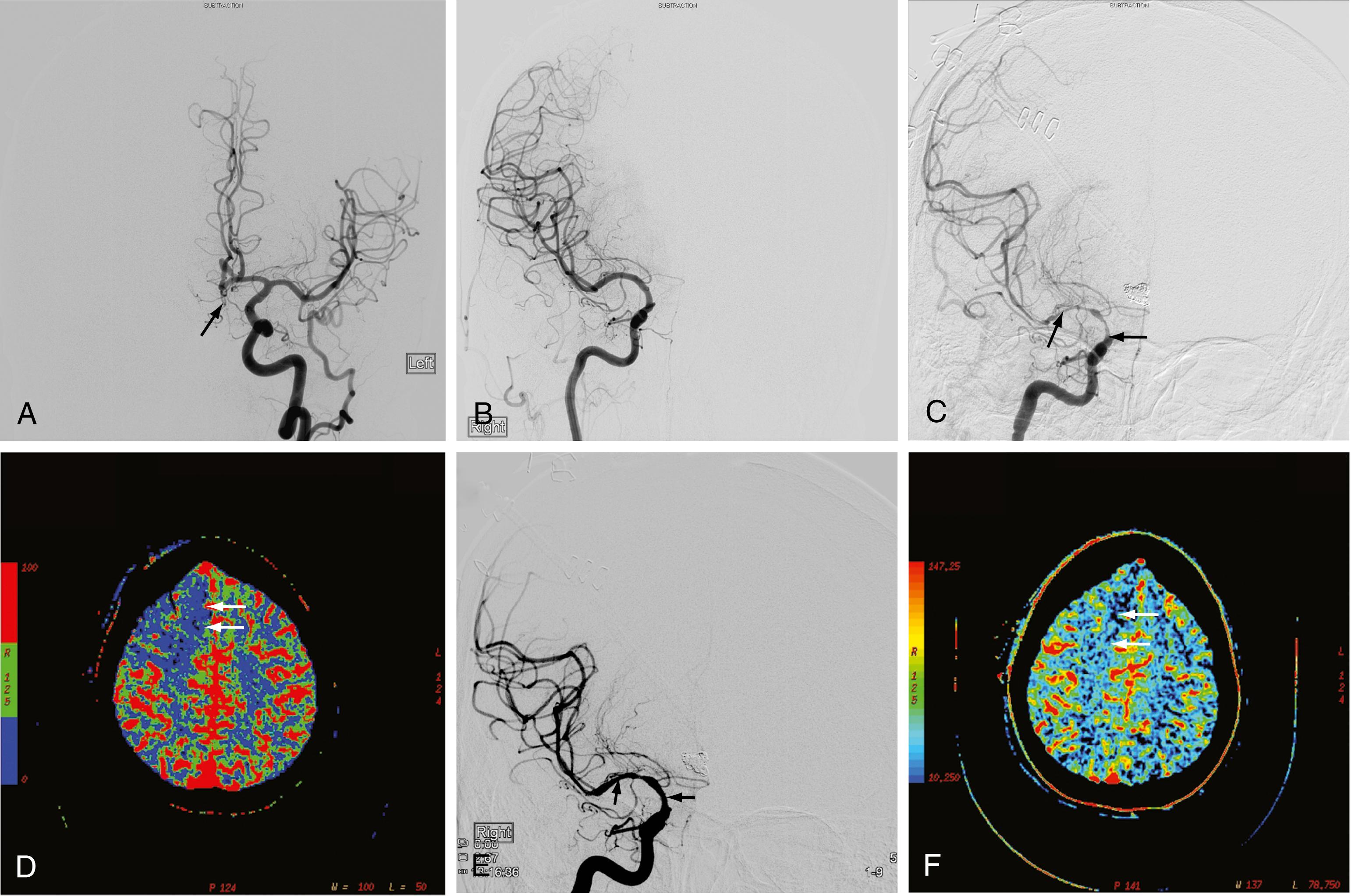 Figure 10.8, (A) Anteroposterior angiogram of the left internal carotid artery (ICA), demonstrating a ruptured aneurysm in the anterior communicating artery (arrow). (B) Anteroposterior angiogram of the right ICA, illustrating absence of the A1 segment of the right anterior cerebral artery and no vasospasm. (C) Anteroposterior angiogram of the right ICA 7 days after admission, showing severe vasospasm of the M1 segment of the right middle cerebral artery (MCA; upward-pointing arrow ) and supraclinoid right ICA (left-pointing arrow). (D) Perfusion computed tomographic map of cerebral blood flow (CBF), demonstrating vasospasm-induced decreased CBF ( blue areas) within the right frontal lobe (arrows). (E) Anteroposterior angiogram of the right ICA after intra-arterial administration of verapamil, showing improved vessel caliber of the MCA (upward-pointing arrow) and ICA (left-pointing arrow). (F) Follow-up perfusion computed tomographic image at the same level as in D, illustrating restored CBF in the right anterior frontal lobe on a CBF color map (arrows).